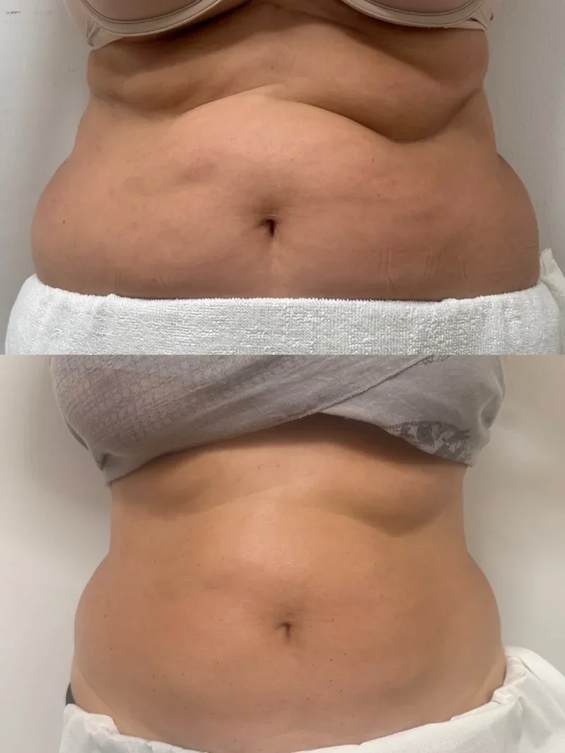 Comparativa antes y después de un tratamiento corporal